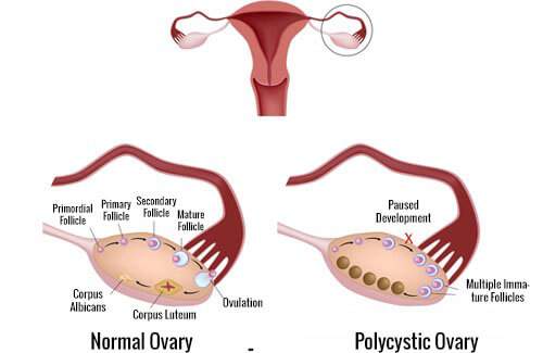 What is PCOS and its treatment