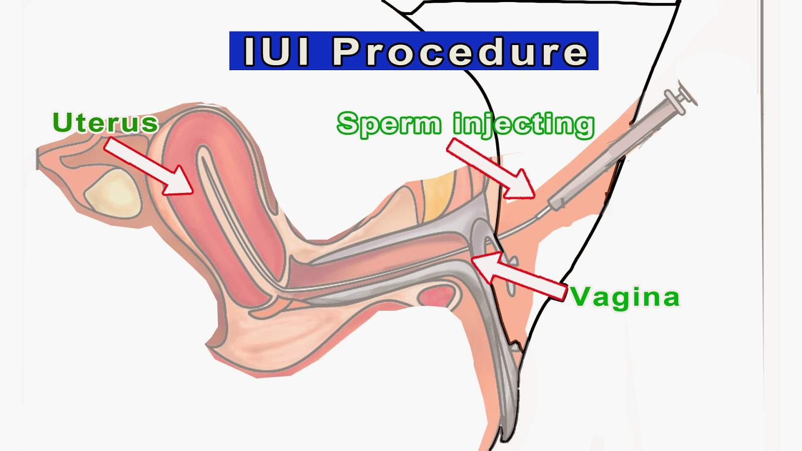 Know About The Procedure Of IUI