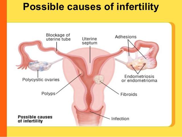 female-infertility-causes