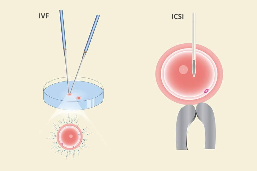 Is ICSI better than IVF (ICSI VS IVF)