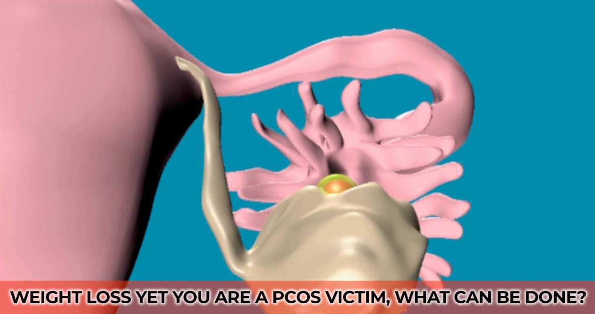 Weight Loss Yet you are a PCOS victim, What can be done?