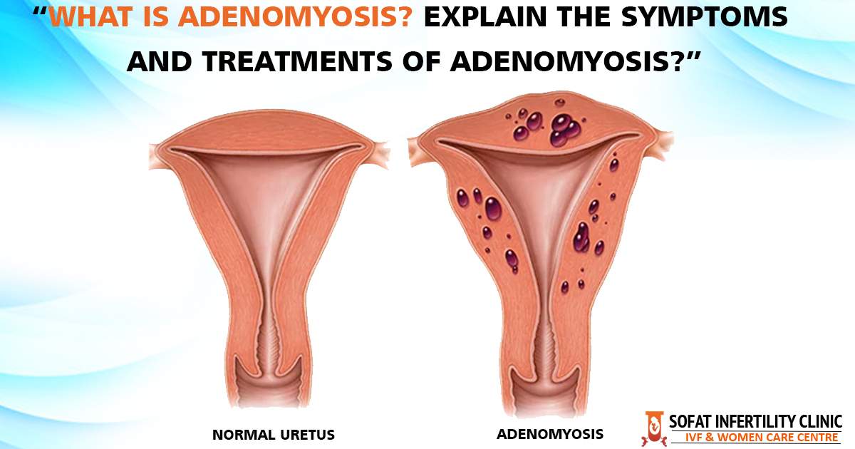 What is Adenomyosis? Explain the symptoms and treatments of Adenomyosis?