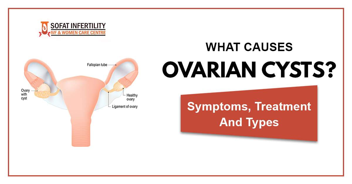 What Causes Ovarian Cysts